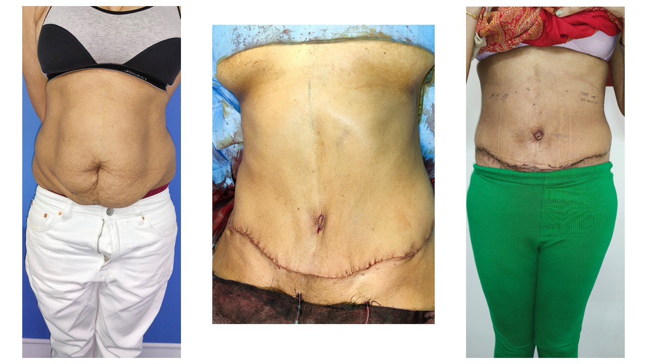 Tummy Tuck Photo 12